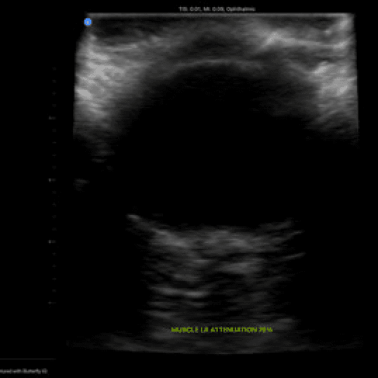 Deep Learning for Ocular Biometry from Ultrasound Images